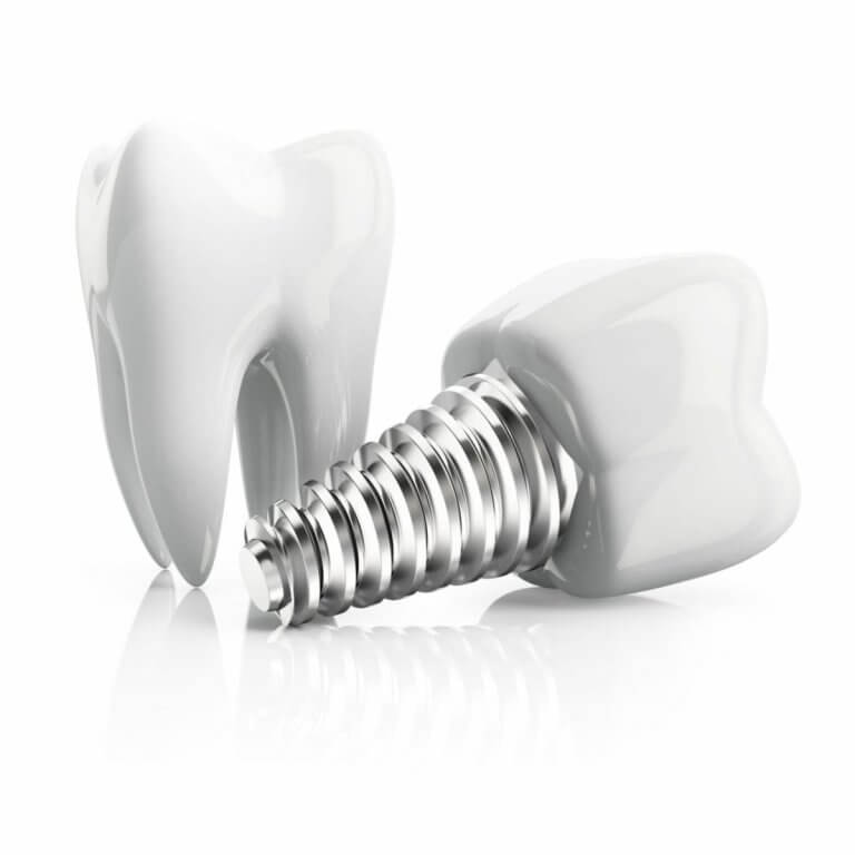 Dental Implant Replacement Teeth