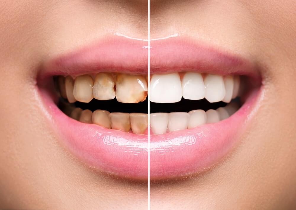 Before & After a Smile Makeover