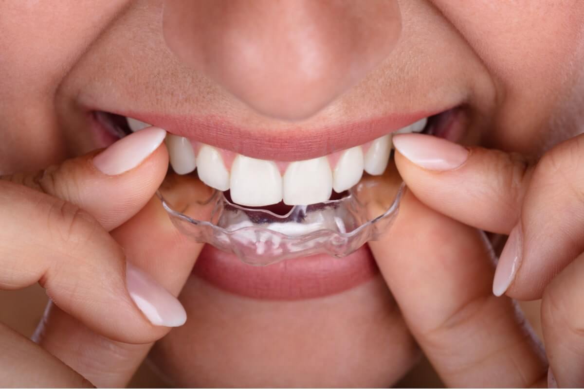 Tooth Movement With Invisalign