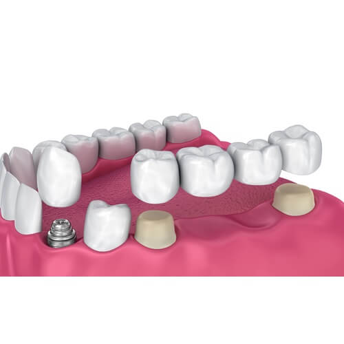 Tooth-supported-fixed-bridge-implant-and-crown.-Medically-accurate-3D-illustration-1