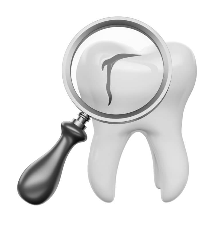 diagnosing a cracked tooth