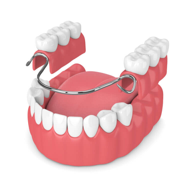 removable dental bridge