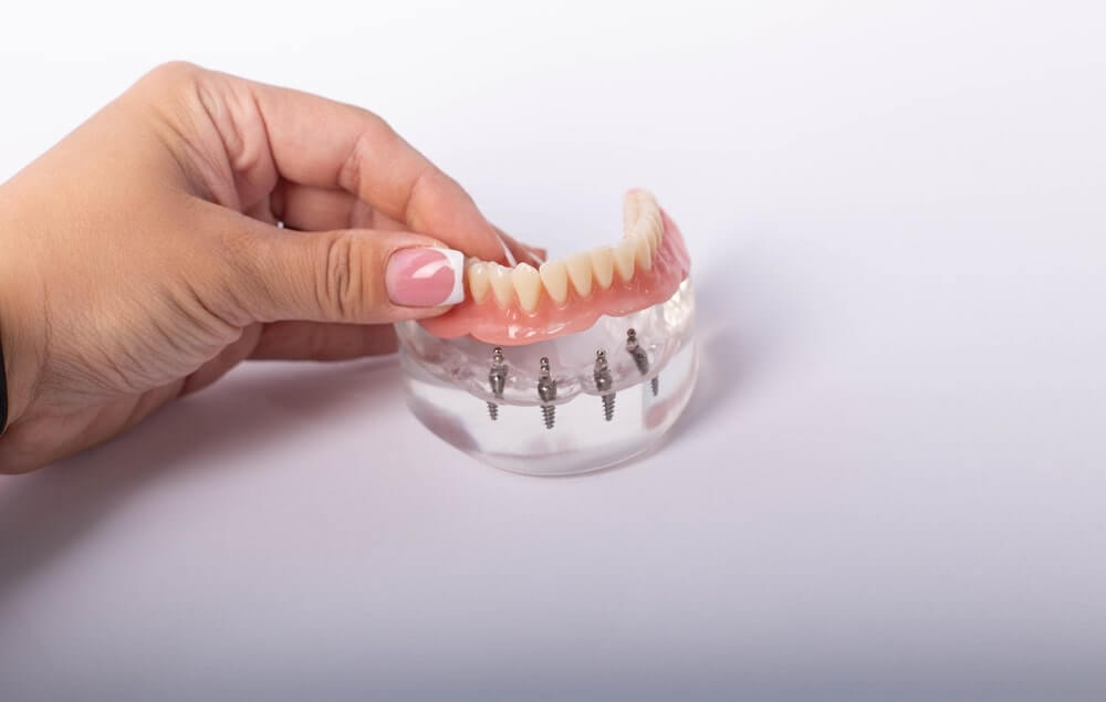 How Many Implants Are Needed for Implant-Supported Dentures