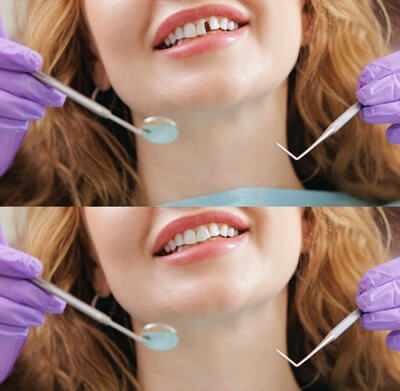 Successful Tooth Restoration