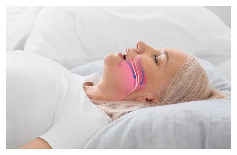 woman with obstructive sleep apnea